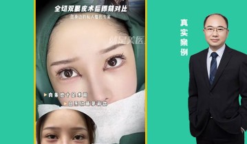 全切双眼皮术后即可对比