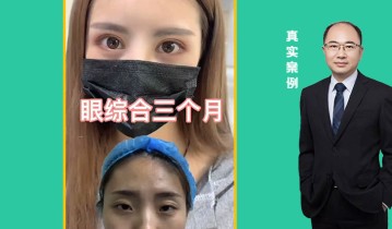 眼综合3个月效果