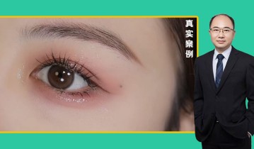 马金荣医生-眼综合双眼皮效果